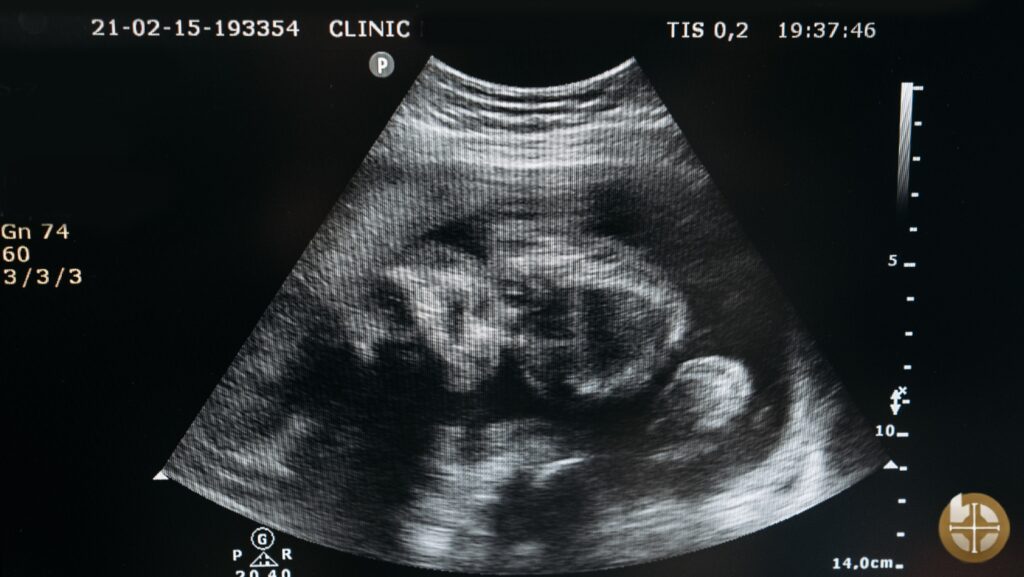 Ultrasound image of a developing fetus.